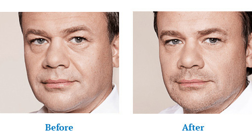 Before after skin care for men in Orchard Park, NY