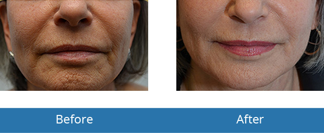 Microneedling treatment best treatments before and after results in the area Orchard Park, NY 