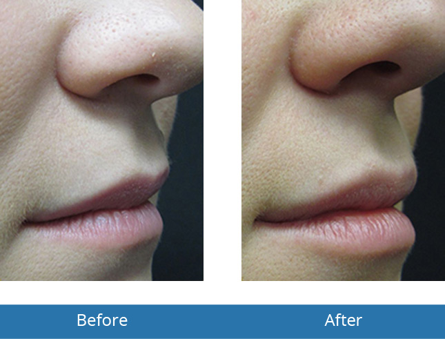 Best Treatment for Lip Filler by Best Dermatologist in Orchard Park, NY 