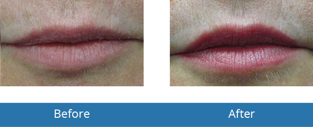Lip Filler treatment by Best Dermatologist in Orchard Park, NY 
