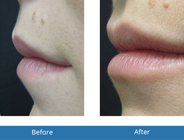 Lip Filler treatment by Best Dermatologist in the area 