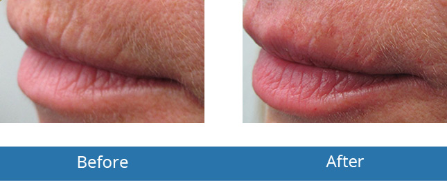 In the area Lip Filler treatment Before and After Best results Orchard Park, NY 