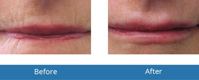 Best Dermatologist in the area Lip Filler treatment Before and After Best results Orchard Park, NY 