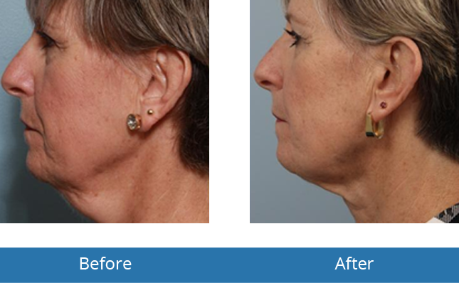 Best Kybella neck treatment Before and After Results in Orchard Park, NY 