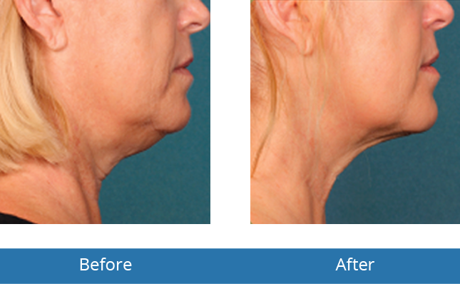 best Kybella neck treatment Before and After Results in Orchard Park, NY 