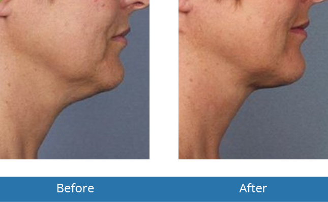 Kybella neck treatment Before and After Results 
