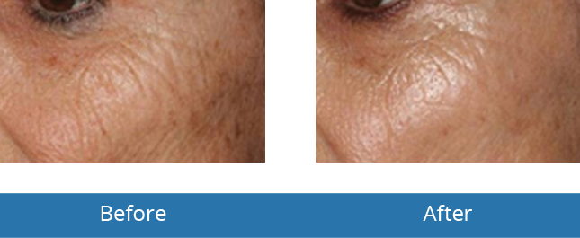 Microneedling treatment best treatments before and after results in the area Orchard Park, NY 