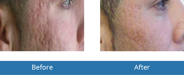 Microneedling before and after results in the area Orchard Park, NY 