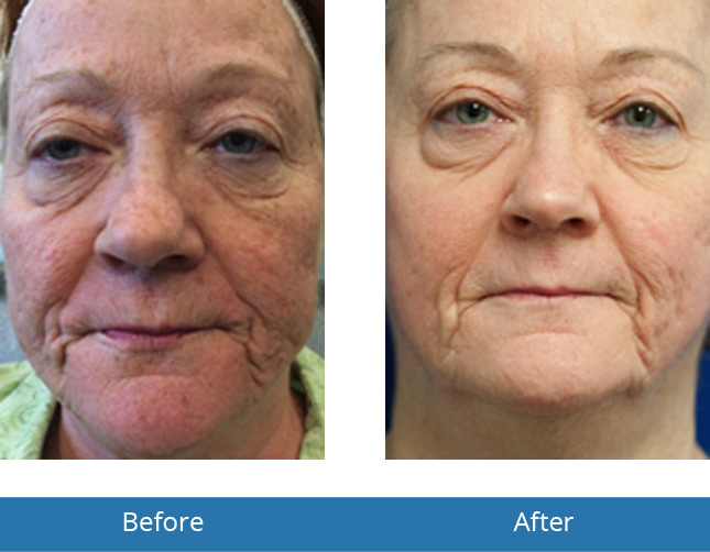 Chemical Peels Before and After Results Orchard Park, NY 