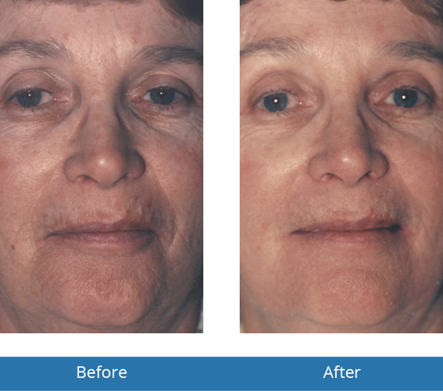 Before and After Results of Chemical Peels in the area of Orchard Park, NY 
