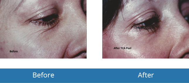 Chemical Peels Before and After Results Orchard Park, NY 