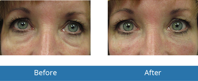 Orchard Park, NY Best Dermatologist in the area Under Eye Fill Before and After Best results 