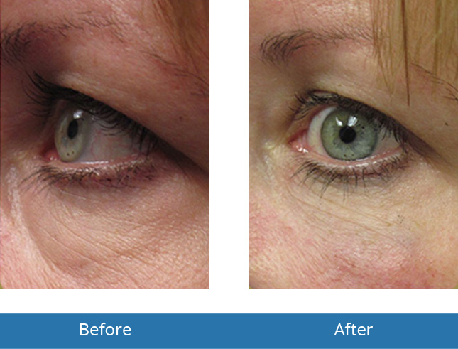 Orchard Park, NY Best Dermatologist in the area Under Eye Fill Before and After Best results 