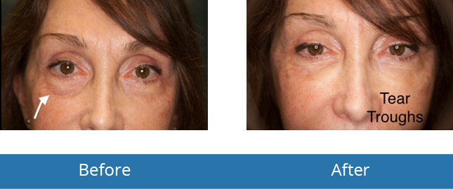 Orchard Park, NY Best Dermatologist in the area Under Eye Fill Before and After results 