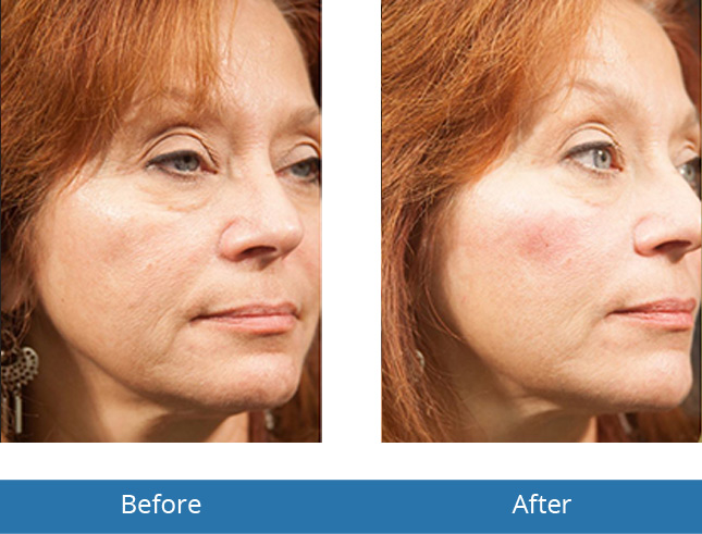 Best Dermatologist in the area Voluma results before and after patients Orchard Park, NY 