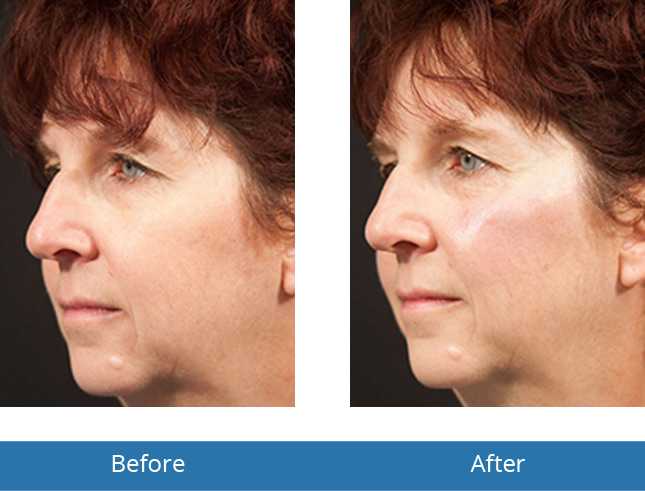 Voluma results before and after patients Orchard Park, NY 