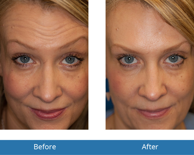 Botox Before and After Results in the area Orchard Park, NY 