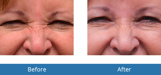 Botox Before and After Patient Results Orchard Park, NY 