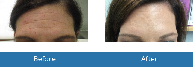 Orchard Park, NY patients Botox Results by Best Dermatologist 
