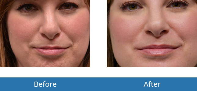 Botox best results Before and After Patient Results Orchard Park, NY 