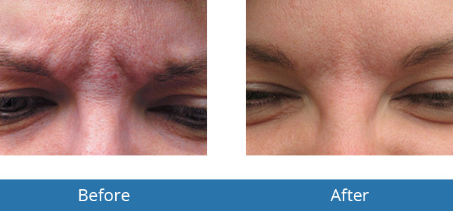 Orchard Park, NY area Botox Patient Results 
