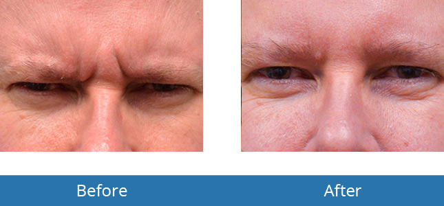 Botox Before and After Patient Results Orchard Park, NY 