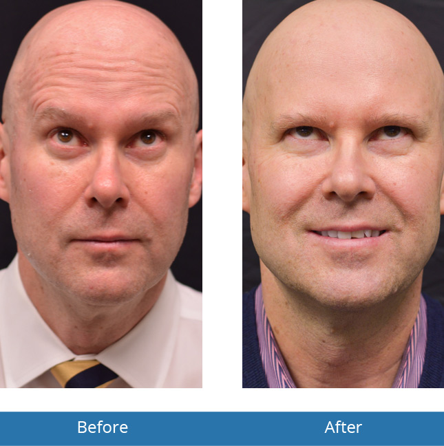Botox Before and After Results Orchard Park, NY 