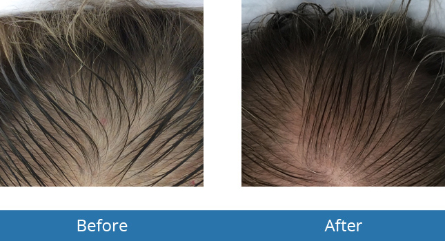 Hair Loss best results Before and After 