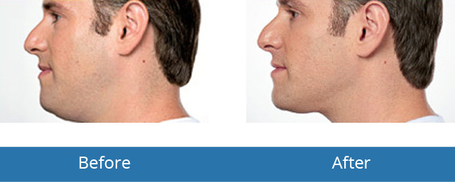 Orchard Park, NY Dermatology for men Before and After Results 