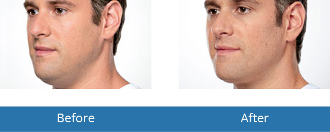 Orchard Park, NY Dermatology for men Before and After Results 