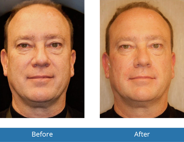 Dermatology for men Before and After Results 