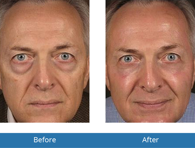 Orchard Park, NY Dermatology for men their face Before and After Results 