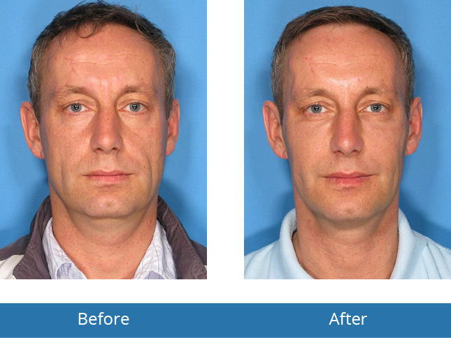 Orchard Park, NY Dermatology for men their face Before and After Results 