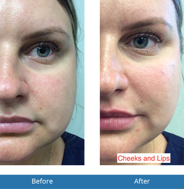 Orchard Park, NY Best Dermatologist in the area Voluma Before and After results 