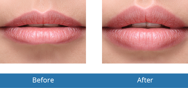 Best Dermatologist in the area Lip Filler Before and After Best results Orchard Park, NY 