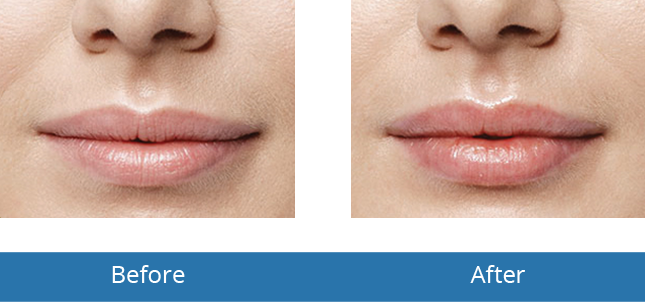 Best Dermatologist in the area Lip Filler Before and After Best results Orchard Park, NY 