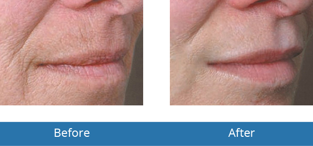 Filler best treatment in the area before and after patients results 