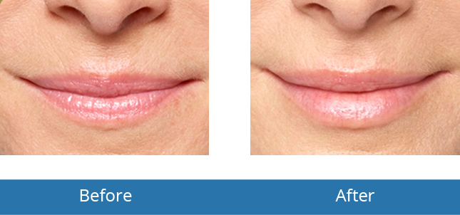 Orchard Park, NY Best Dermatologist in the area Lip Filler Before and After Best results 