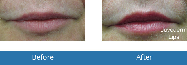 Best Results of Lip Filler in the area by best dermatologist 